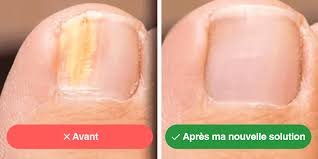 avant apres mycose ail